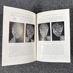 Conduction Infiltration General Anesthesia Dentistry 1943 4th Nevin & Puterbaugh
