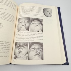 Cleft Craft Vol 2 Evolution Of Its Surgery The Unilateral Deformity Millard 1977
