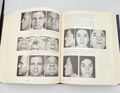 Cleft Craft Vol 2 Evolution Of Its Surgery The Unilateral Deformity Millard 1977