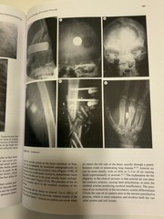 Brogdon’s Forensic Radiology by Michael J Thali M D: Used