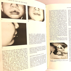 Vintage Cleft Lip and Palate Surgical Dental and Speech Book Hardcover 1971