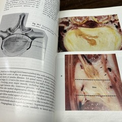 Lumbar Spine 2nd Edition Volumes 1 2 Medical Textbook Anatomy Orthopedic Surgery