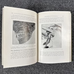 Conduction Infiltration General Anesthesia Dentistry 1943 4th Nevin & Puterbaugh