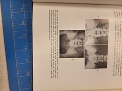 AAOS Symposium on The Spine American Academy of Orthopaedic Surgeons 1969 Book