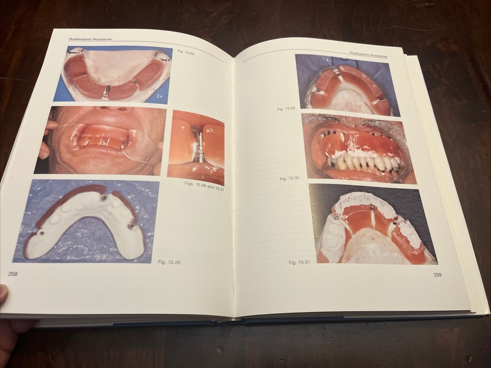 Tissue-Integrated Prostheses Osseointegration In clinical dentistry, Illustrated